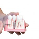 正しい歯科インプラント医療機関の選び方